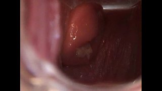 Avy ເປີດການຜ່າຕັດ Speculum